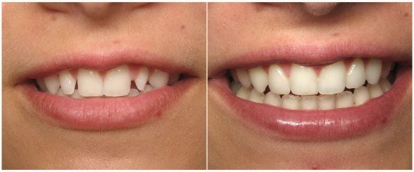 Керамические коронки на передние зубы до и после