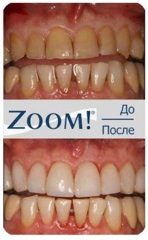Отбеливание зубов Zoom